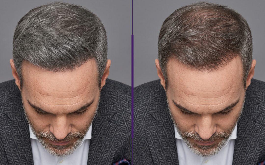 Is Your Hair Falling Out? What Now?