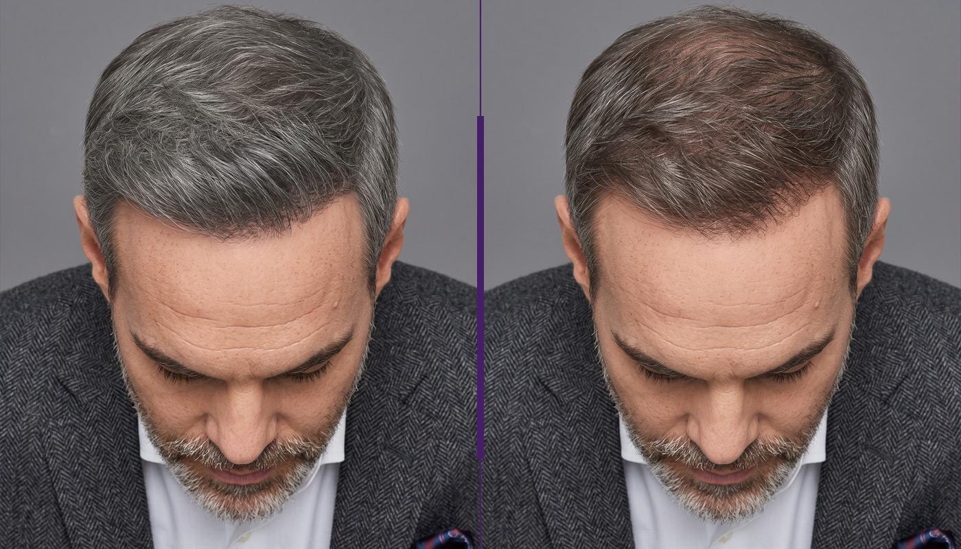 Is Your Hair Falling Out? Here’s what may be happening, and what you can actually do about it. Is Your Hair Falling Out? Here’s what may be happening, and what you can actually do about it.